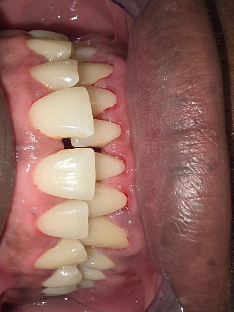 After dental treatment result case 02