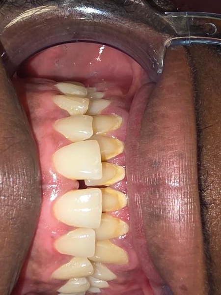 Before dental treatment result case 02